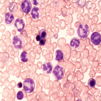An image of treatment-resistant chronic myeloid leukemia cells.